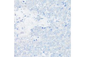 Immunohistochemistry of paraffin-embedded Human liver cancer (negative control sample) using MUC1 Rabbit mAb (ABIN7268687) at dilution of 1:100 (40x lens). (MUC1 antibody)