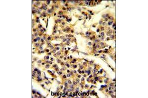 Formalin-fixed and paraffin-embedded human breast carcinoma reacted with CYP2A13 Antibody , which was peroxidase-conjugated to the secondary antibody, followed by DAB staining. (CYP2A13 antibody  (C-Term))