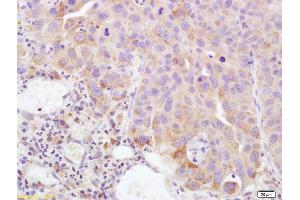 Formalin-fixed and paraffin embedded human bladder carcinoma labeled with Rabbit Anti PTGEs Polyclonal Antibody, Unconjugated (ABIN735788) at 1:200 followed by conjugation to the secondary antibody and DAB staining (Prostaglandin E Synthase antibody  (AA 85-152))