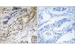 Immunohistochemistry analysis of paraffin-embedded human colon carcinoma tissue, using LAMA3 Antibody.