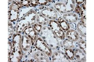 Immunohistochemical staining of paraffin-embedded Carcinoma of liver tissue using anti-GBE1 mouse monoclonal antibody.