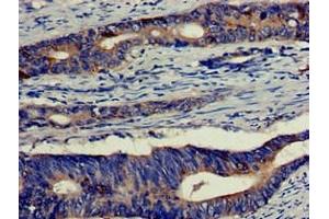 Immunohistochemistry of paraffin-embedded human colon cancer using ABIN7152180 at dilution of 1:100 (EIF4B antibody  (AA 362-590))