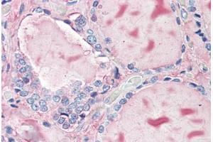Human Thyroid (formalin-fixed, paraffin-embedded) stained with TG antibody ABIN396967 at 10 ug/ml followed by biotinylated anti-mouse IgG secondary antibody ABIN481714, alkaline phosphatase-streptavidin and chromogen. (Thyroglobulin antibody)