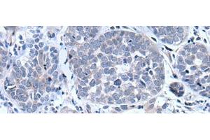 Immunohistochemistry of paraffin-embedded Human esophagus cancer tissue using BTG4 Polyclonal Antibody at dilution of 1:55(x200) (BTG4 antibody)