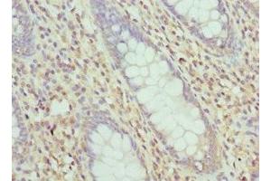 Immunohistochemistry of paraffin-embedded human colon cancer using ABIN7158340 at dilution of 1:100 (LIMS1 antibody  (AA 1-325))