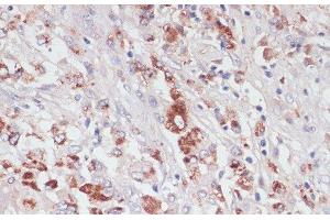 Immunohistochemistry of paraffin-embedded Human liver cancer using LYZ Polyclonal Antibody at dilution of 1:100 (40x lens). (LYZ antibody)