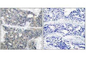 Immunohistochemical analysis of paraffin-embedded human breast carcinoma tissue using p70 S6 Kinase(Phospho-Thr421) Antibody(left) or the same antibody preincubated with blocking peptide(right). (RPS6KB1 antibody  (pThr421))