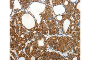 Immunohistochemistry of Human colon cancer using SLC12A4 Polyclonal Antibody at dilution of 1:30 (SLC12A4 antibody)