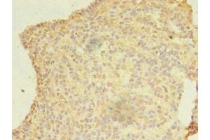 Immunohistochemistry of paraffin-embedded human breast cancer using ABIN7174932 at dilution of 1:100 (CFAP92/KIAA1257 antibody  (AA 1-297))