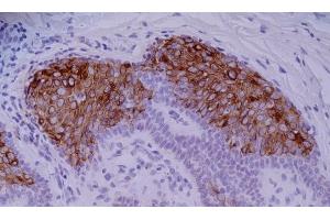 Immunohistochemistry staining of skin basaliom (paraffin-embedded sections) with anti-human Cytokeratin 10 (VIK-10). (Keratin 10 antibody)