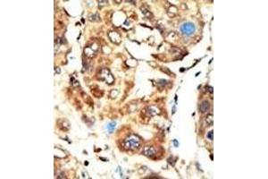 Formalin-fixed and paraffin-embedded human cancer tissue reacted with the primary antibody, which was peroxidase-conjugated to the secondary antibody, followed by AEC staining. (MAGI1 antibody  (C-Term))