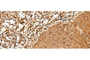 Immunohistochemistry of paraffin-embedded Human esophagus cancer tissue using FAM50A Polyclonal Antibody at dilution of 1:25(x200) (FAM50A antibody)