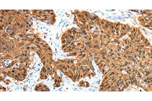 Immunohistochemistry of paraffin-embedded Human esophagus cancer using ADAMTS5 Polyclonal Antibody at dilution of 1:30