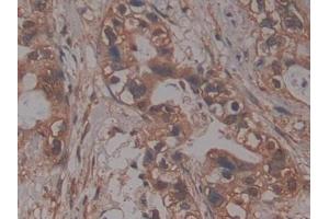 IHC-P analysis of Human Pancreatic cancer Tissue, with DAB staining. (PRCP antibody  (AA 108-376))