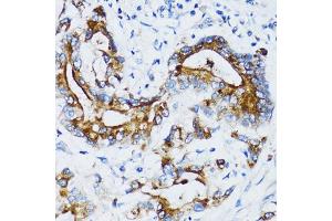 Immunohistochemistry of paraffin-embedded human colon carcinoma using MMP7 antibody. (MMP7 antibody)