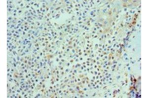 Immunohistochemistry of paraffin-embedded human breast cancer using ABIN7156850 at dilution of 1:100 (IL-21 antibody  (AA 25-162))