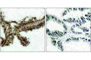 Immunohistochemistry analysis of paraffin-embedded human lung carcinoma, using Akt (Phospho-Thr308) Antibody.