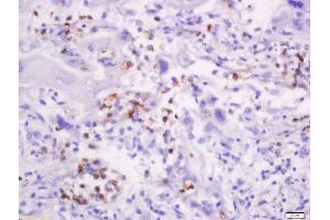 Formalin-fixed and paraffin embedded human lung carcinoma labeled with Anti-CD58/LFA-3 Polyclonal Antibody, Unconjugated  at 1:200 followed by conjugation to the secondary antibody and DAB staining.