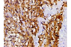ABIN6267443 at 1/200 staining human meningeal carcinomatosis(MC) tissue sections by IHC-P. (Cofilin antibody  (pSer3))