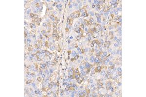 Immunohistochemistry of paraffin-embedded human liver cancer using RA/B Rabbit mAb (ABIN7269790) at dilution of 1:100 (40x lens). (RAB11A antibody)