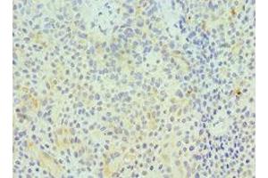 Immunohistochemistry of paraffin-embedded human breast cancer using ABIN7154414 at dilution of 1:100 (GZMA antibody  (AA 29-262))