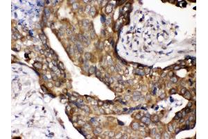 Anti- POR Picoband antibody,IHC(P) IHC(P): Human Mammary Cancer Tissue (POR antibody  (C-Term))