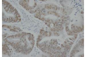 Immunohistochemistry (IHC) image for anti-Tumor Protein P53 (TP53) antibody (ABIN1108553) (p53 antibody)