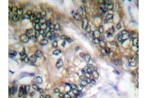 Immunohistochemistry analyzes of Separase antibody in paraffin-embedded human colon carcinoma tissue. (Separase antibody)