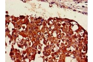 Immunohistochemistry of paraffin-embedded human breast cancer using ABIN7169405 at dilution of 1:100 (SESN1 antibody  (AA 224-337))