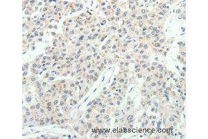 Immunohistochemistry of Human lung cancer using RPAP3 Polyclonal Antibody at dilution of 1:20