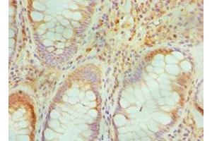 Immunohistochemistry of paraffin-embedded human colon cancer using ABIN7172842 at dilution of 1:100 (TGFBI antibody  (AA 30-250))