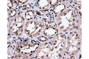 Immunohistochemical staining of paraffin-embedded Carcinoma of prostate tissue using anti-CISD1 mouse monoclonal antibody. (CISD1 antibody)