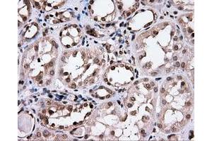 Immunohistochemical staining of paraffin-embedded Carcinoma of prostate tissue using anti-CISD1 mouse monoclonal antibody.