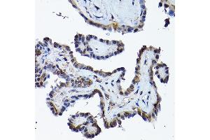 Immunohistochemistry of paraffin-embedded human thyroid cancer using PRMT5 Rabbit pAb (ABIN3022065, ABIN3022066, ABIN3022067 and ABIN6218592) at dilution of 1:200 (40x lens).