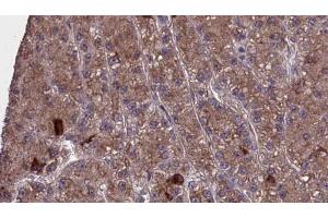 ABIN6273977 at 1/100 staining Human liver cancer tissue by IHC-P. (OR2H1 antibody  (C-Term))