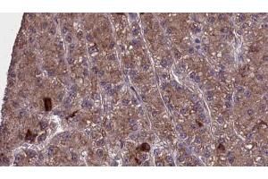 ABIN6273977 at 1/100 staining Human liver cancer tissue by IHC-P.