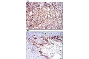 Immunohistochemical staining of human liver cancer tissues (A) and esophageal tissues (B) with FTL monoclonal antibody, clone 8E1E7  at 1:200-1:1000 dilution.