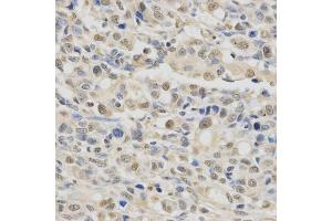 Immunohistochemistry of paraffin-embedded human gastric cancer using SPHK1 Antibody (ABIN5970017) at dilution of 1/200 (40x lens). (SPHK1 antibody)