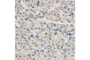 Immunohistochemistry of paraffin-embedded human gastric cancer using SPHK1 Antibody (ABIN5970017) at dilution of 1/200 (40x lens).