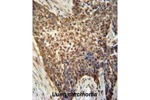 METTL4 antibody (C-term) immunohistochemistry analysis in formalin fixed and paraffin embedded human Lung carcinoma followed by peroxidase conjugation of the secondary antibody and DAB staining. (METTL4 antibody  (C-Term))