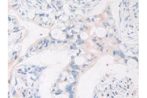 Detection of FDFT1 in Human Bile duct cancer Tissue using Polyclonal Antibody to Farnesyl Diphosphate Farnesyltransferase 1 (FDFT1)