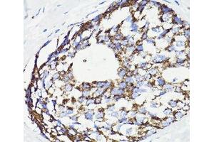 Immunohistochemistry of paraffin-embedded Human breast cancer using PDCD10 Polyclonal Antibody at dilution of 1:100 (40x lens). (PDCD10 antibody)