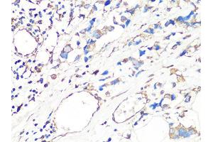 Immunohistochemistry of paraffin-embedded human breast cancer using MMP2 Antibody (ABIN4904395) at dilution of 1:100 (40x lens). (MMP2 antibody)
