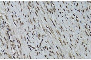 Immunohistochemistry of paraffin-embedded Human uterine cancer using LKB1 Polyclonal Antibody at dilution of 1:100 (40x lens). (LKB1 antibody)