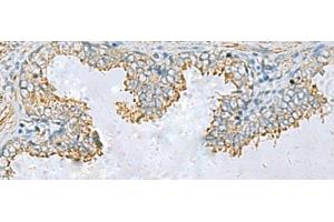 Immunohistochemistry of paraffin-embedded Human prost ate cancer tissue using PLA2G15 Polyclonal Antibody at dilution of 1:65(x200) (PLA2G15 antibody)