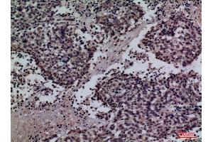 Immunohistochemistry (IHC) analysis of paraffin-embedded Human Lung Cancer, antibody was diluted at 1:100. (Surfactant Protein A1 antibody  (Internal Region))