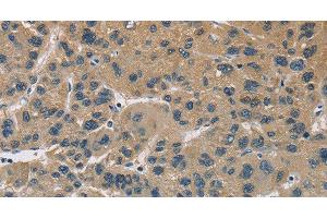Immunohistochemistry of paraffin-embedded Human liver cancer using CYR61 Polyclonal Antibody at dilution of 1:60 (CYR61 antibody)