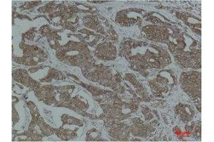 Immunohistochemistry (IHC) analysis of paraffin-embedded Human Breast Carcinoma using Calnexin Polyclonal Antibody. (Calnexin antibody)