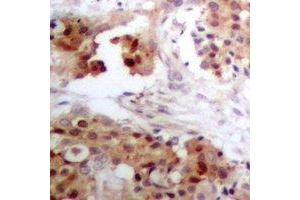 Immunohistochemical analysis of APOBEC3G staining in human breast cancer formalin fixed paraffin embedded tissue section. (APOBEC3G antibody)