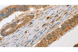 Immunohistochemistry of paraffin-embedded Human colon cancer tissue using Granzyme B Polyclonal Antibody at dilution 1:30 (GZMB antibody)